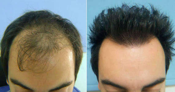 alopecia